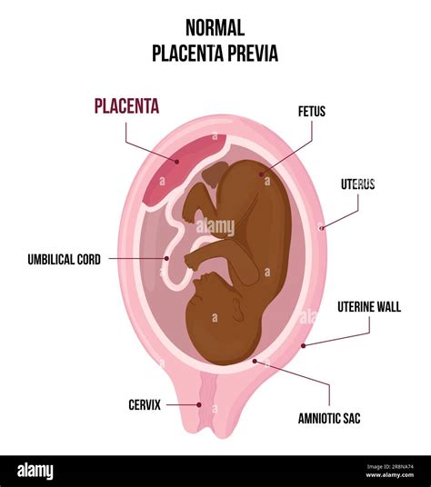 https://example.com/images/placenta_calcifiere_infografic.jpg