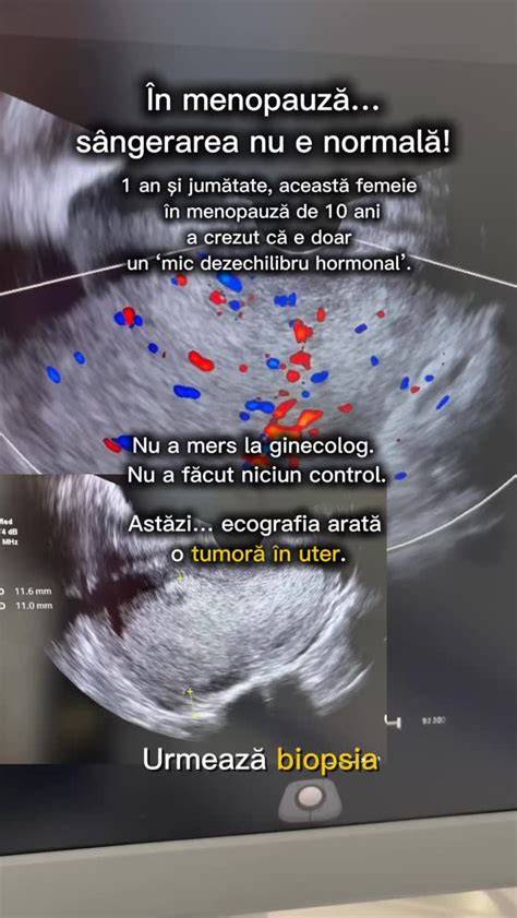 Schema: pregătire endometru și momentul transferului în cicluri naturale vs. artificiale