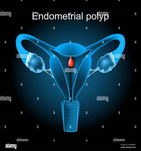 Infografic: etape chiuretaj uterin endometrial