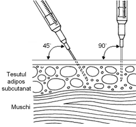 Ilustrație a modului de administrare a injecției subcutanate cu Fraxiparine
