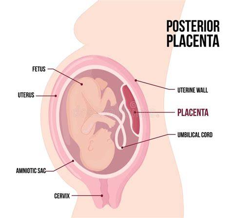Diagramă schematizând inserția anormală a placentei în cicatricea cezariană