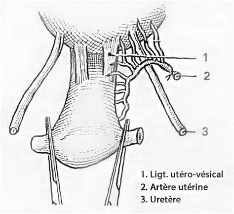 Schema surgicală a reconstrucției tranșei uterine post-cezariană