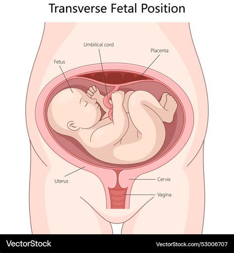 Ilustrație a poziției fetale transversale