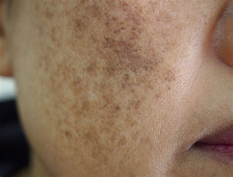 Exemplu de melasma pe față