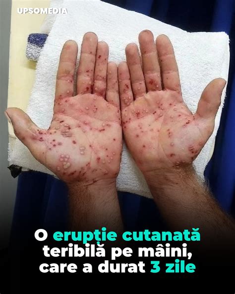 Exemplu de erupție cutanată PUPPP