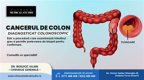 Schema flux terapeutic pentru cancerul de colon stâng