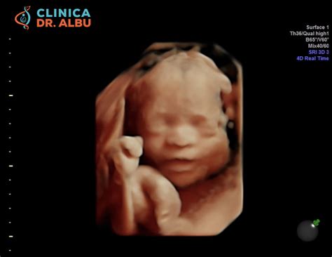 Ecografie morfologică trimestru 1