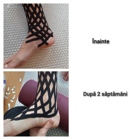 Ilustrație a relaxinei și efectul său asupra ligamentelor pelvine