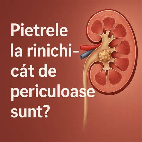 Infografic despre traseul calculului renal de la rinichi la vezică