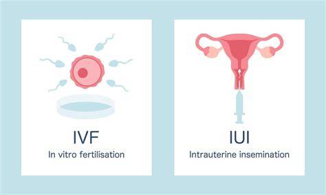 Imagine: harta fluxurilor de tratament pentru infertilitate (IUI, FIV, donare)