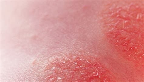 Bebelus cu eruptie cutanata pe fata