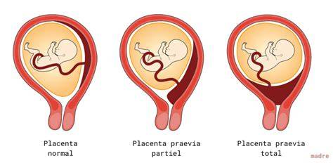 Infografic: Clasificări ale placentae praevia și planuri de naștere