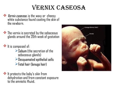 Vernix caseosa pe pielea unui nou-născut, cu distribuție în falduri