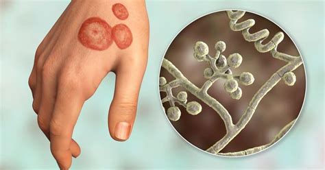 Ilustrație cu ciuperca Malassezia pe piele