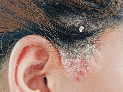 Infografic: Pași pentru îngrijirea bebelușului cu dermatită seboreică