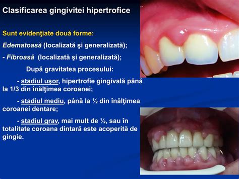 Ilustrație a gingivitei de sarcină