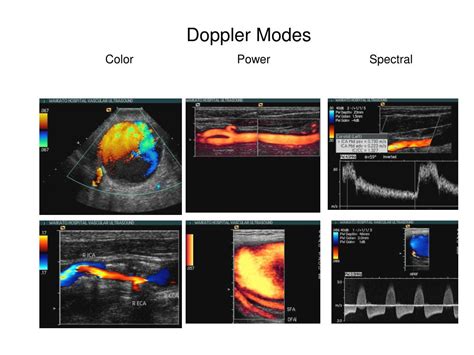 Infografic despre tipuri de Doppler (color, spectral, duplex, power)