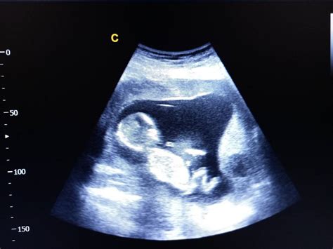 ecografie sarcina prezentatie pelviana