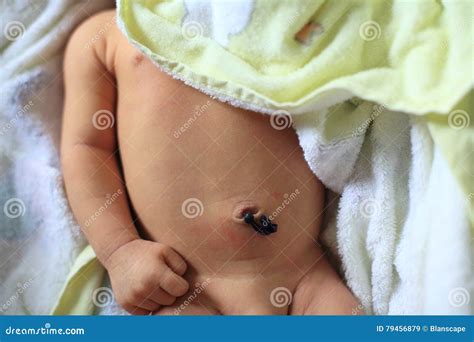 prolaps cordon ombilical