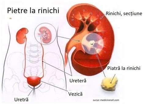 Formarea pietrelor la rinichi