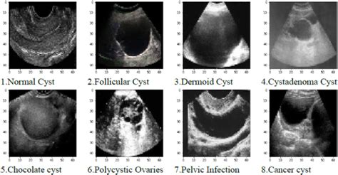 Ilustrație anatomică a ovarelor și a diferitelor tipuri de chisturi ovariene
