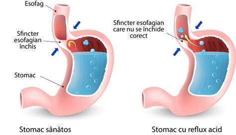 Schemă: Bariera anti-reflux la nivelul sfincterului esofagian inferior