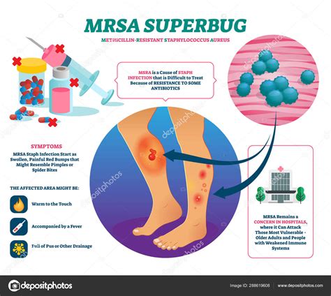 Infografic: windows de transmitere MRSA si scheme de tratament