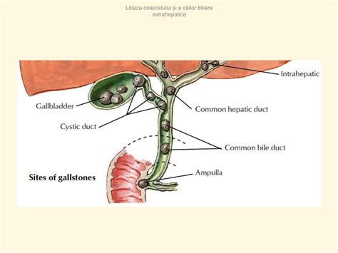 Ilustrație a calculilor biliari și a căilor biliare