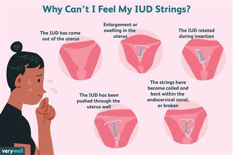 Diagram of how an IUD is placed in the uterus and how the threads remain in the vaginal canal