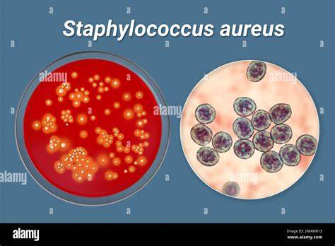 Grafic: Rute de transmitere a Staphylococcus aureus