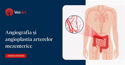 Infografic: cum funcționează stentarea și angioplastia