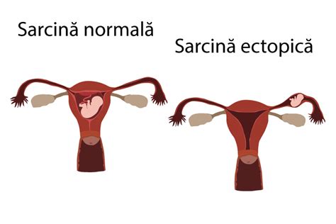 Grafic: Comparatie risc sarcina ectopica la utilizatoare DIU vs. non-DIU