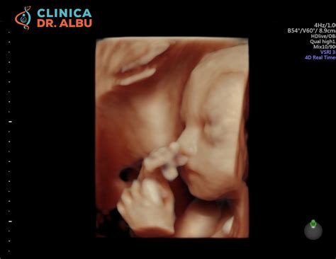 Ecografie morfologică de trimestrul 2