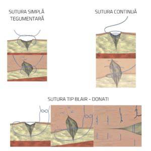 Diagrame de tipuri de suturi și alegerea lor în epiziotomie