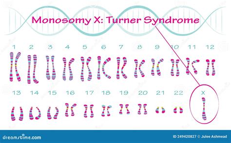 Infografic: tipuri de sindrom Turner (monosomie X, mozaicism, anomalii structurale)