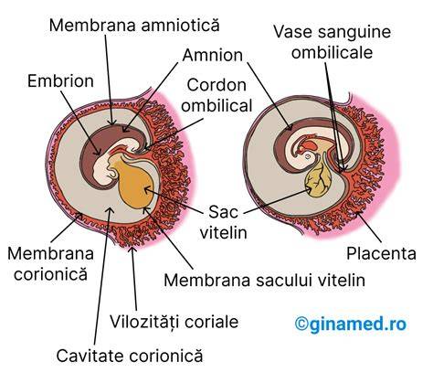 Schema posibilelor complicatii ale cordonului ombilical