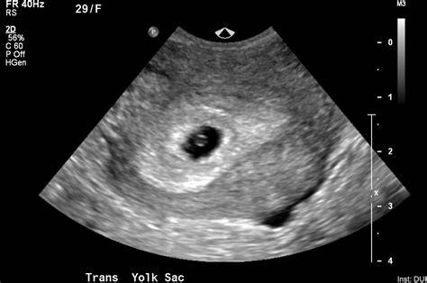 ecografie-sarcina-timpurie-sac-gestational