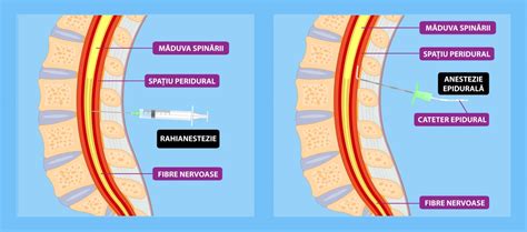 Diagramă comparativă: rahianestezie vs. epidurală vs. generală
