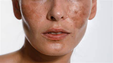 Melasma si linia nigra pe burtă