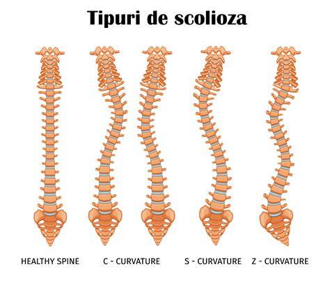 Infografic: Cum afectează scolioza sarcina și principalele ajustări psihomotorii