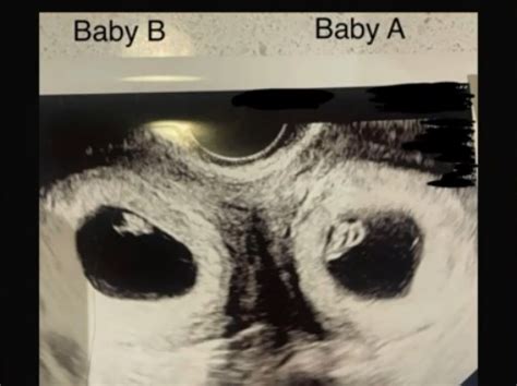 Ecografie gemeni în uter - imagine medicală
