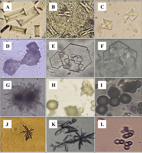 Sediment urinar la microscop