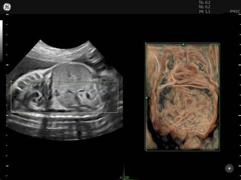 Ecografie morfologie fetala T3