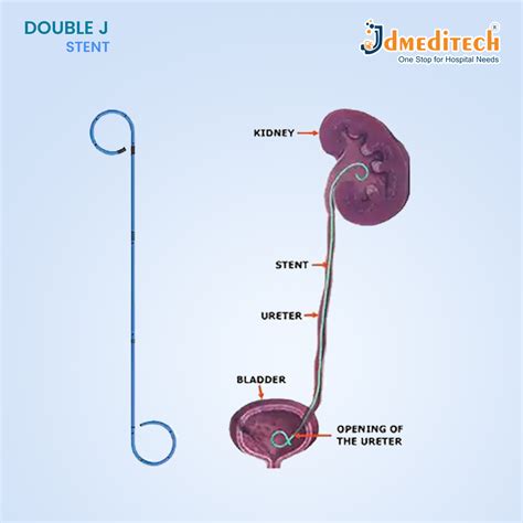 Schema: flux de drenaj în ureterohidronefroză pregnantă (stent JJ vs nefrostomie)
