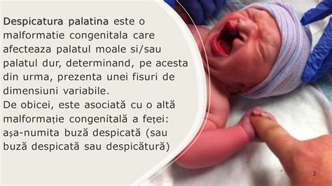 Bebeluș cu palat despicat