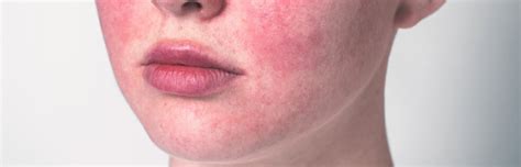 pete rosii pe burta caine