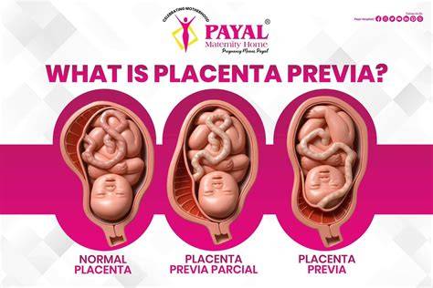 ecografie placenta previa
