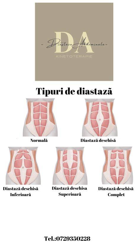 Infographic despre planșeul pelvin, diastază abdominală și core stabil