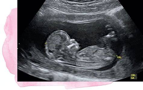 Ecografie obstetricală - exemplu imagistic