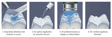 Schema: cum funcționează sigilarea dentară
